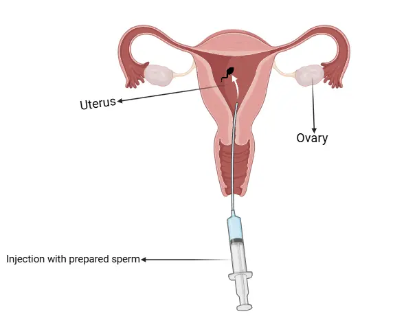 IUI